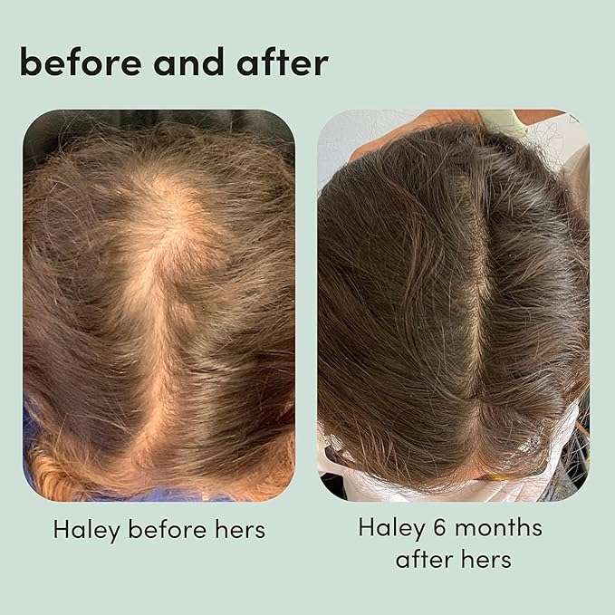 hers Topical Minoxidil Solution, 2% - Hair Growth Treatment for Women - Clinically Proven to Reduce Hair Loss